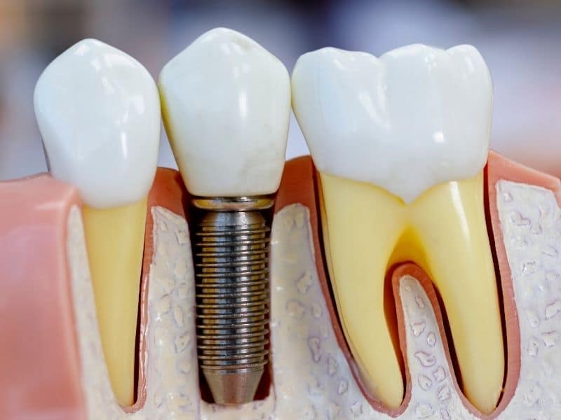 Dental model showing a titanium implant screw between natural teeth