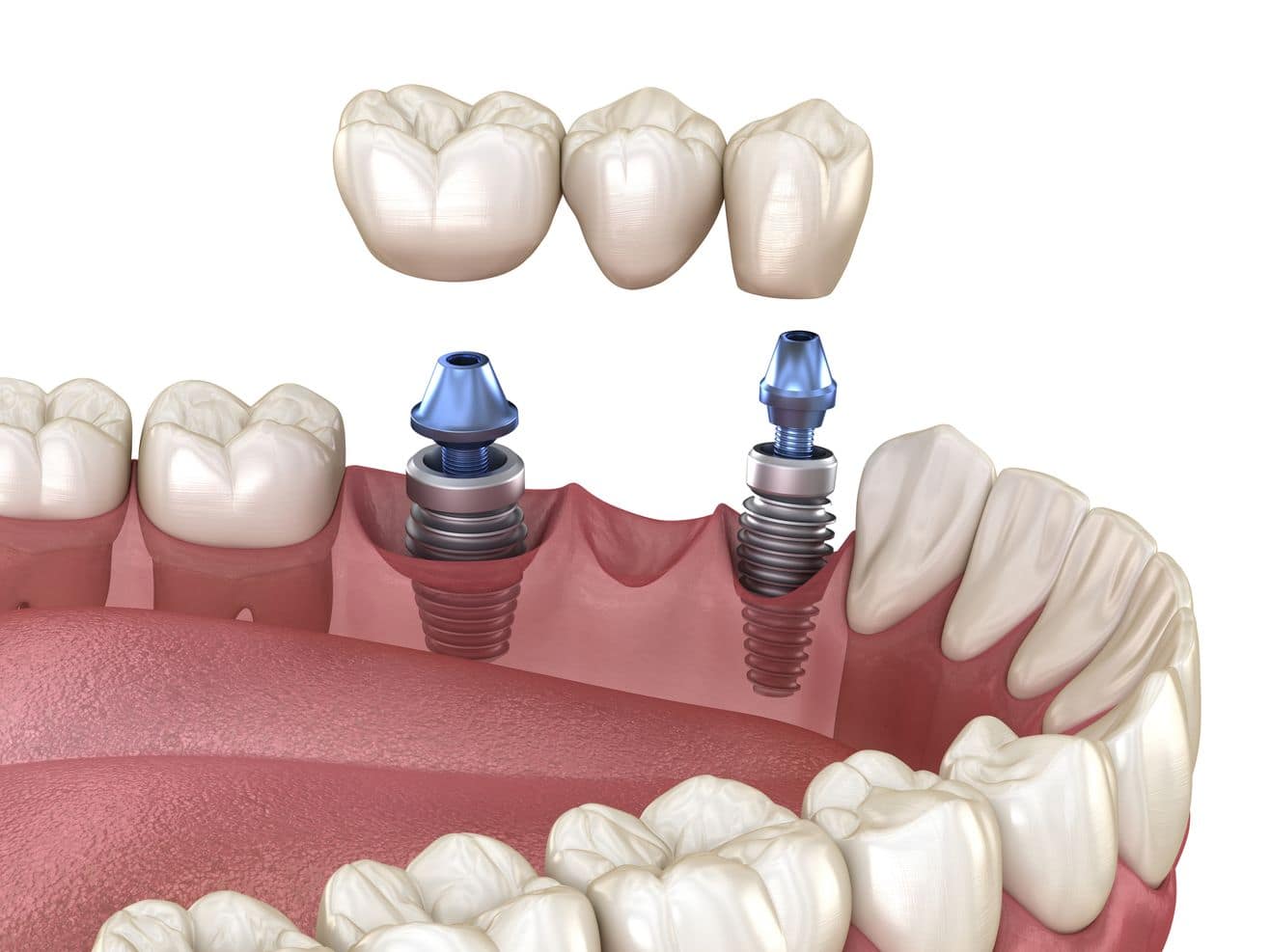 Illustration of an implant-supported dental bridge