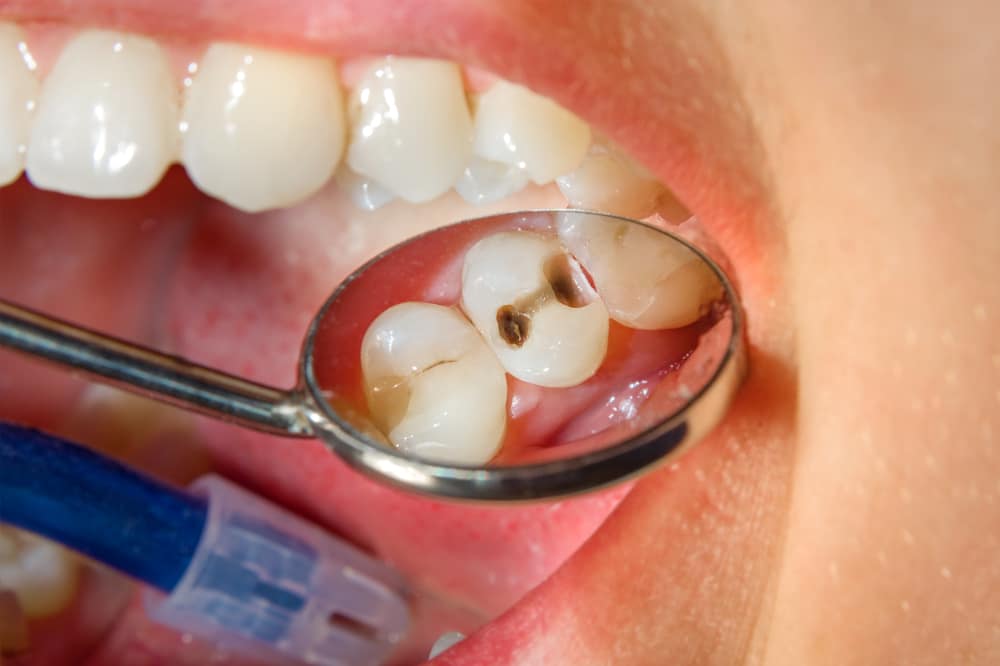 Close-up of a tooth with a cavity being examined with a dental mirror