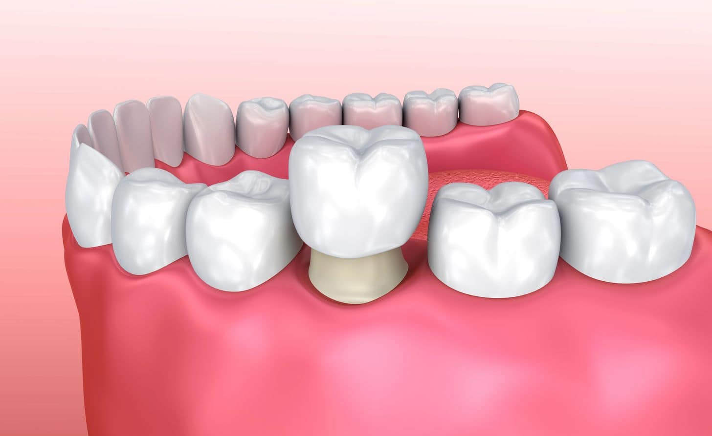 Illustration of a dental crown being placed on a tooth