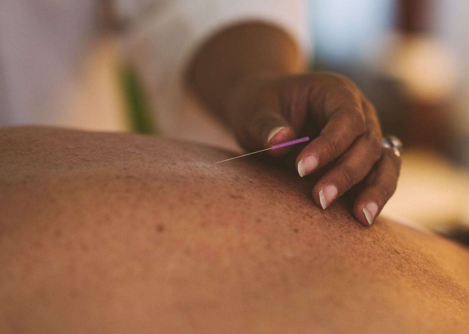 Acupuncture needle being placed in a patient's shoulder