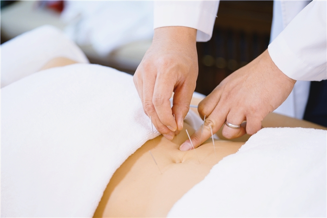 Acupuncture needles being placed along a patient's lower back