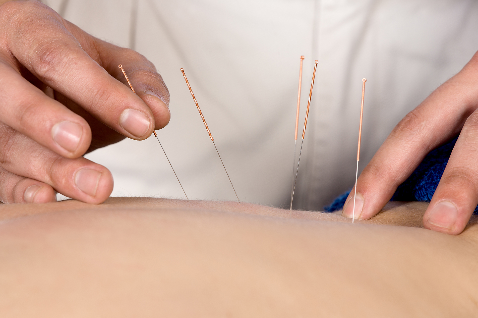 Hands placing multiple acupuncture needles into a patient's lower back