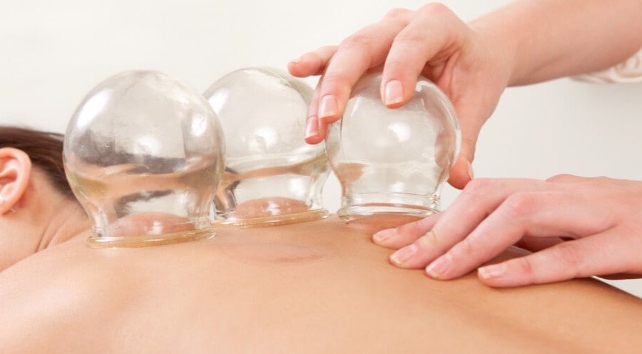 Cupping therapy with glass suction cups applied to a patient's back