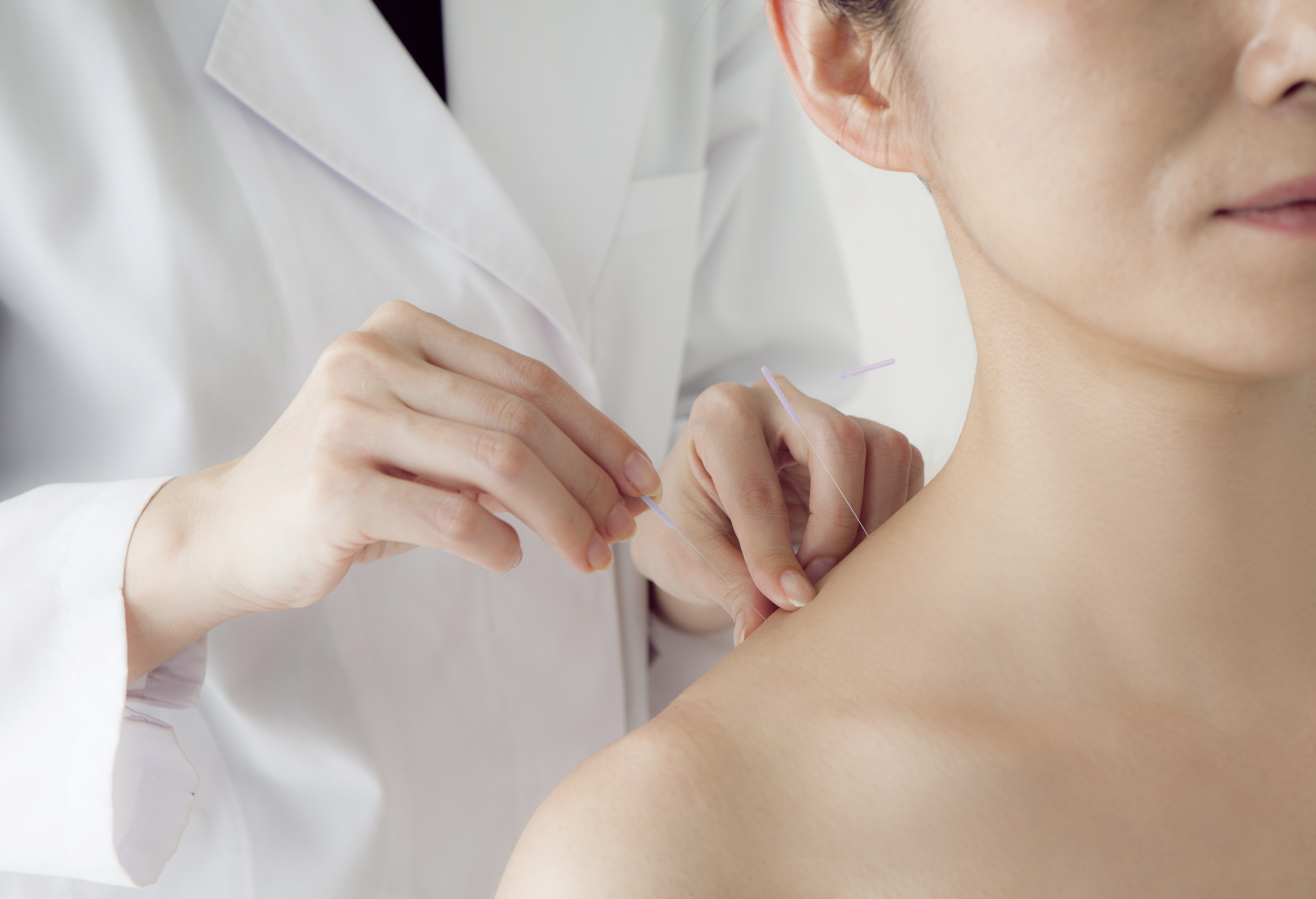 Practitioner performing acupuncture on a patient's shoulder during an initial consultation