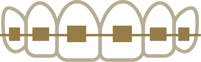 Line drawing of upper teeth with traditional braces brackets and wire