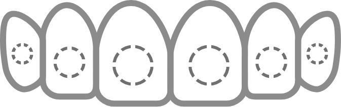 Line drawing of upper teeth with hidden BRAVA bracket indicators