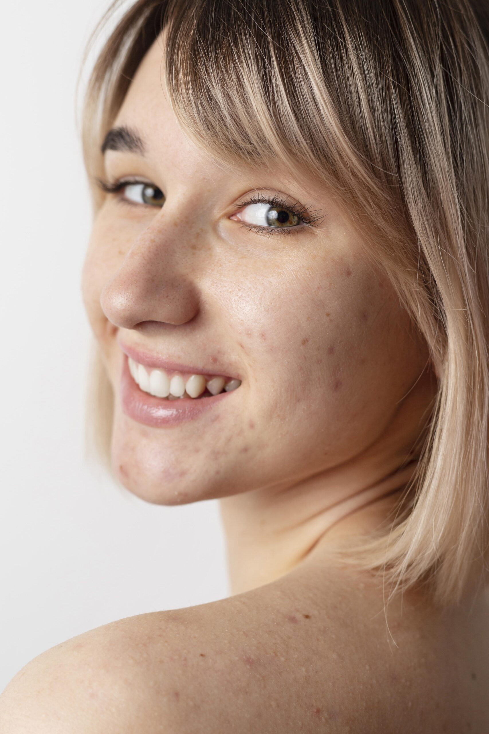 Smiling woman with acne-prone skin, close-up portrait