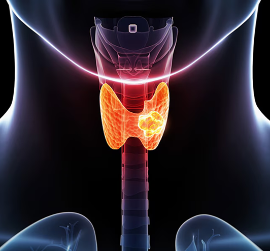 3D illustration of the thyroid gland with a highlighted nodule