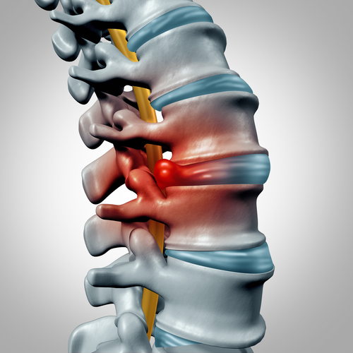 3D medical illustration of a herniated spinal disc with an inflamed red bulge