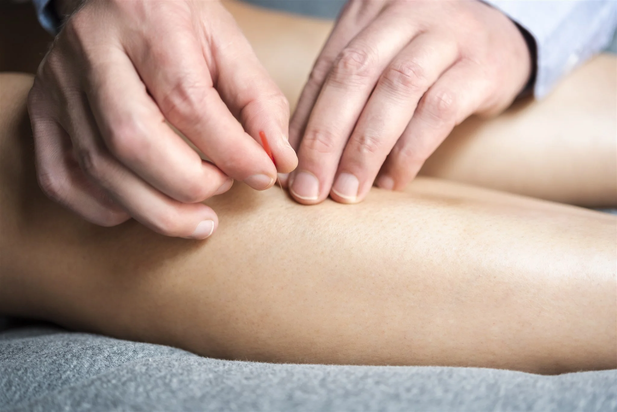 Acupuncture needle being placed during a treatment