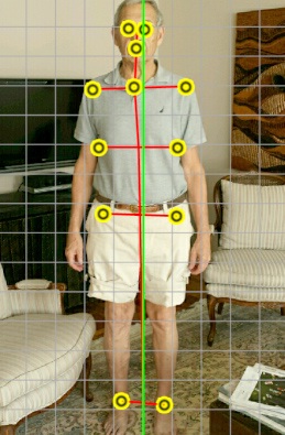 Posture assessment photo with body-alignment grid and yellow marker dots