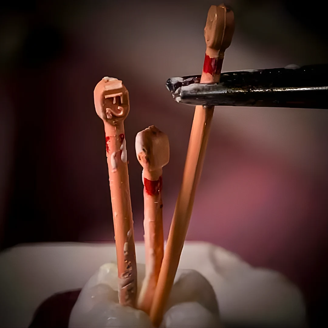Root canal posts held with forceps — advanced dentistry