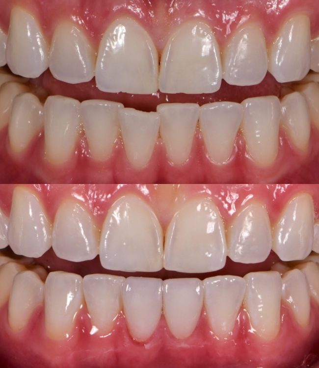 Before and after: bonding and alignment improvement