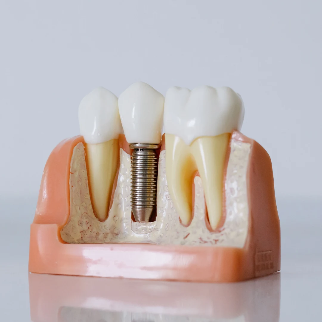 Dental implant model with crown — dental implantology