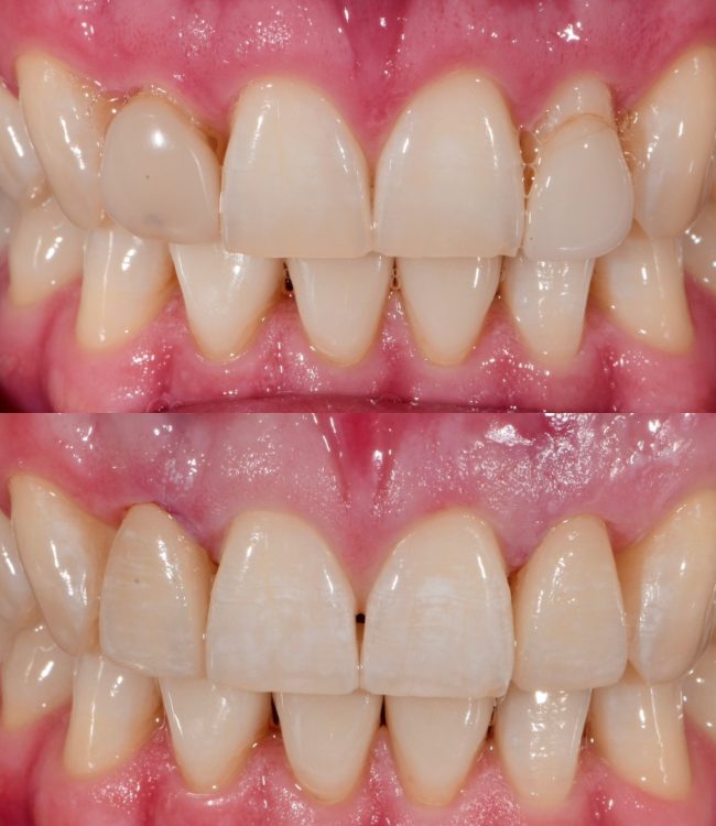 Before and after: spaced teeth closed and whitened