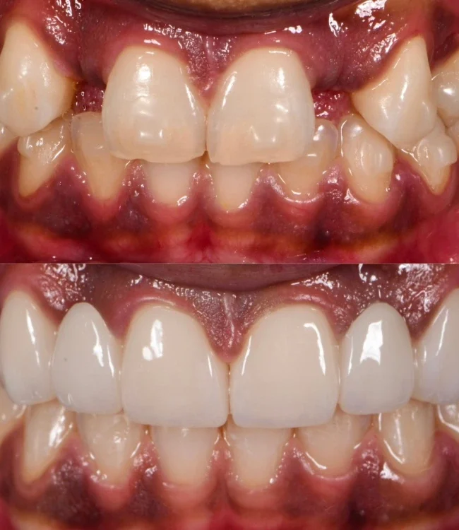 Before and after: crowding corrected with alignment treatment
