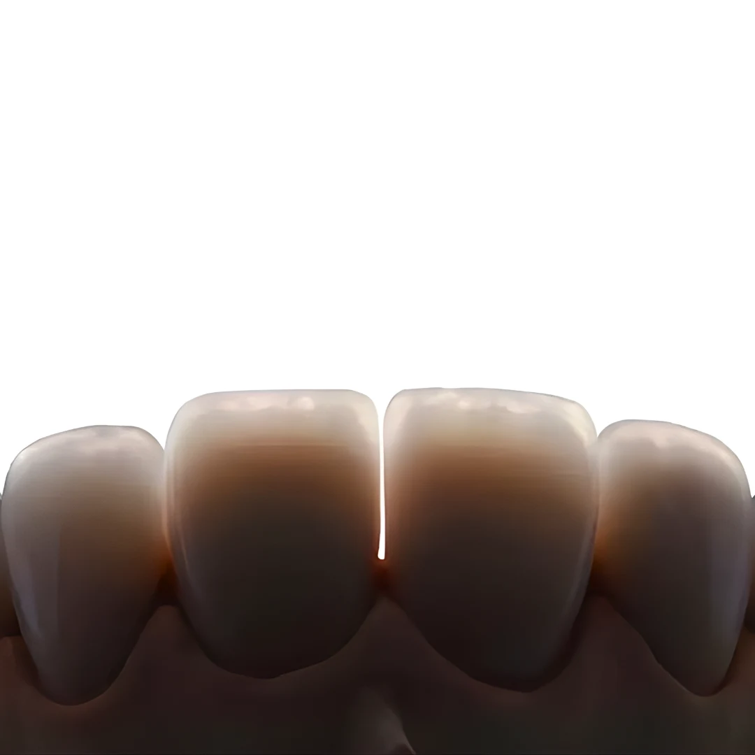 Porcelain veneer crowns — cosmetic dentistry