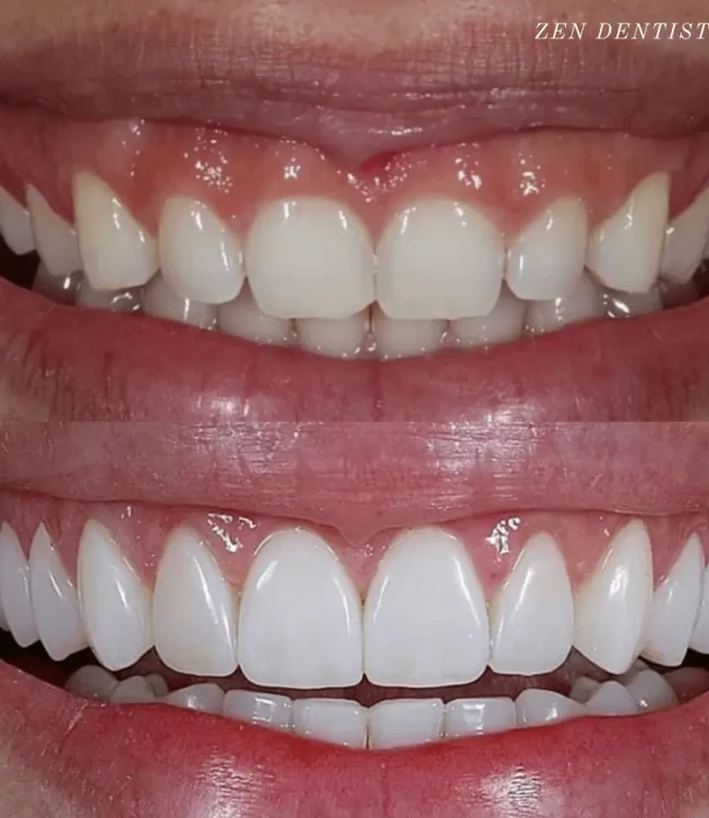 Before and after: gummy smile corrected with veneers