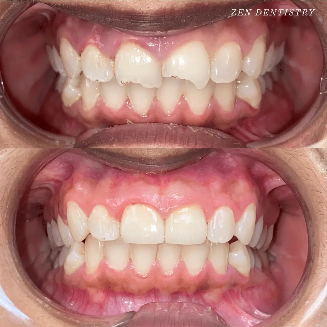 Before and after: composite bonding