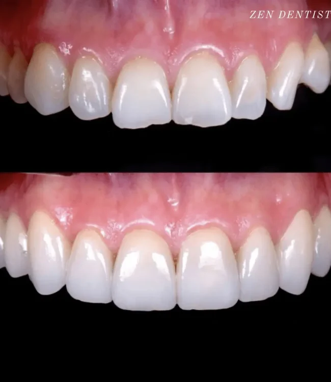 Before and after: chipped upper front teeth restored with veneers
