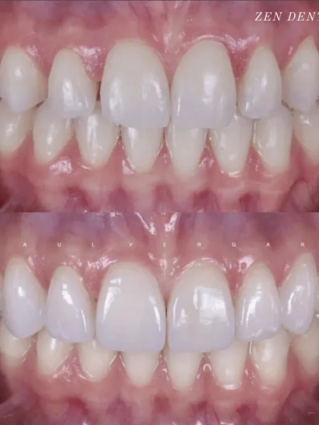 Before and after: upper front tooth alignment