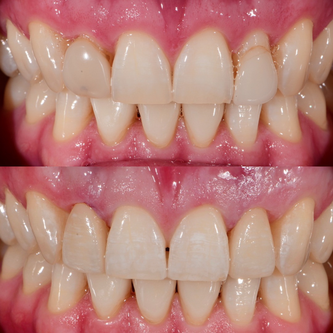 Before and after: upper lateral porcelain veneers