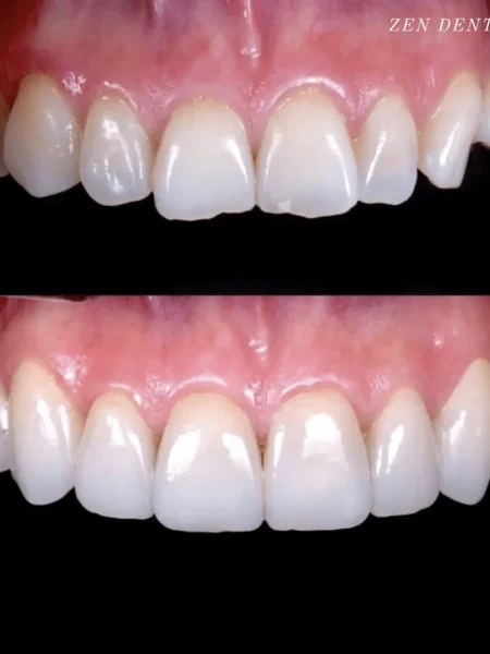 Before and after: chipped teeth restored with veneers