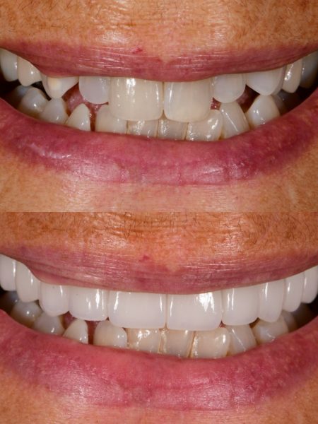 Before and after: discoloured teeth restored with veneers