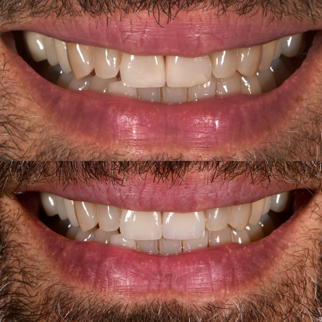 Before and after: upper central porcelain veneers