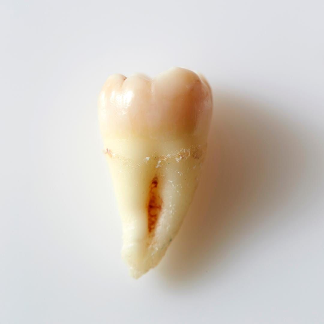 Extracted molar tooth — oral surgery