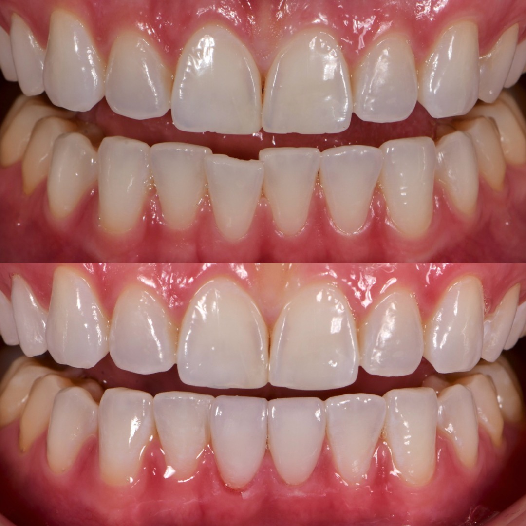 Before and after: lower veneers