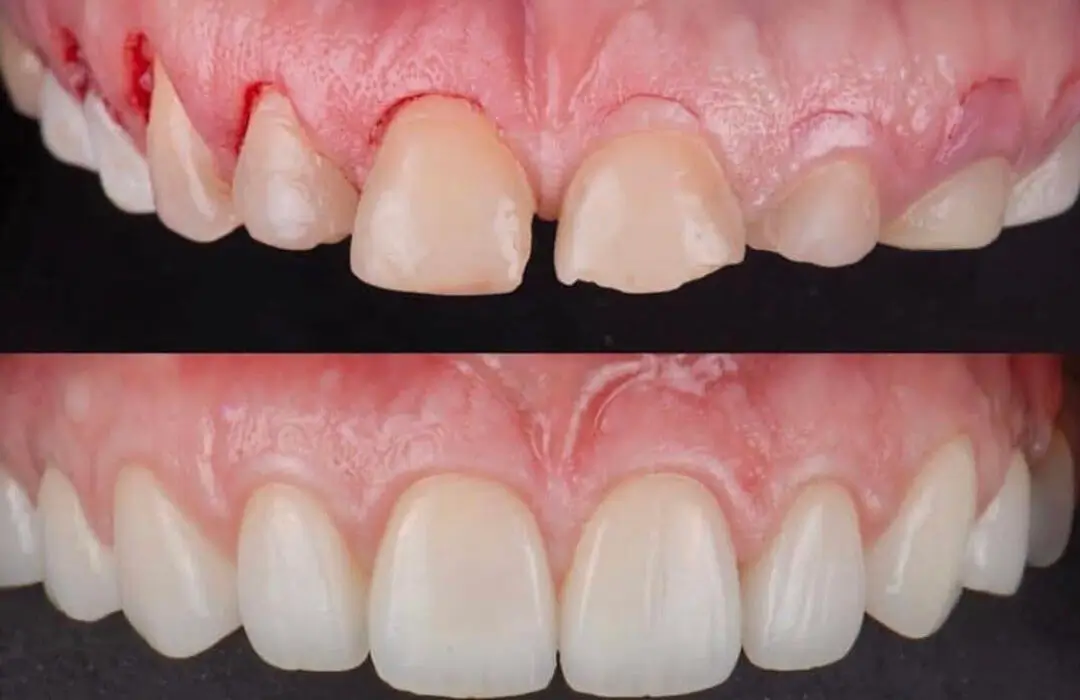 Before and after: severely worn teeth restored with porcelain veneers