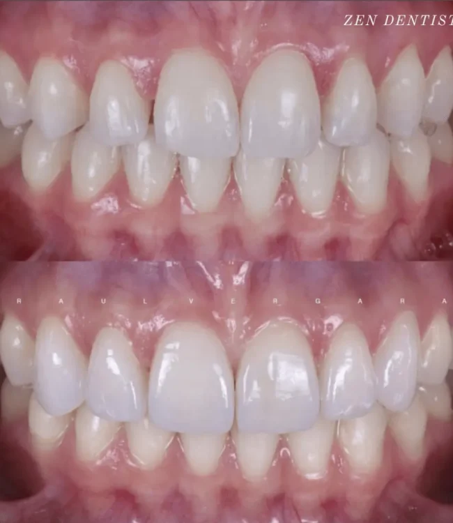 Before and after: teeth straightening result