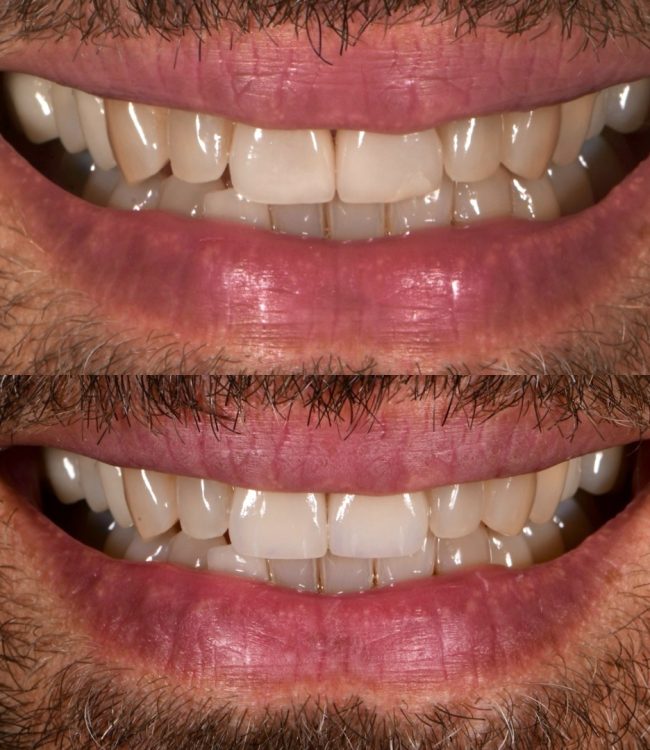 Before and after: veneer smile makeover