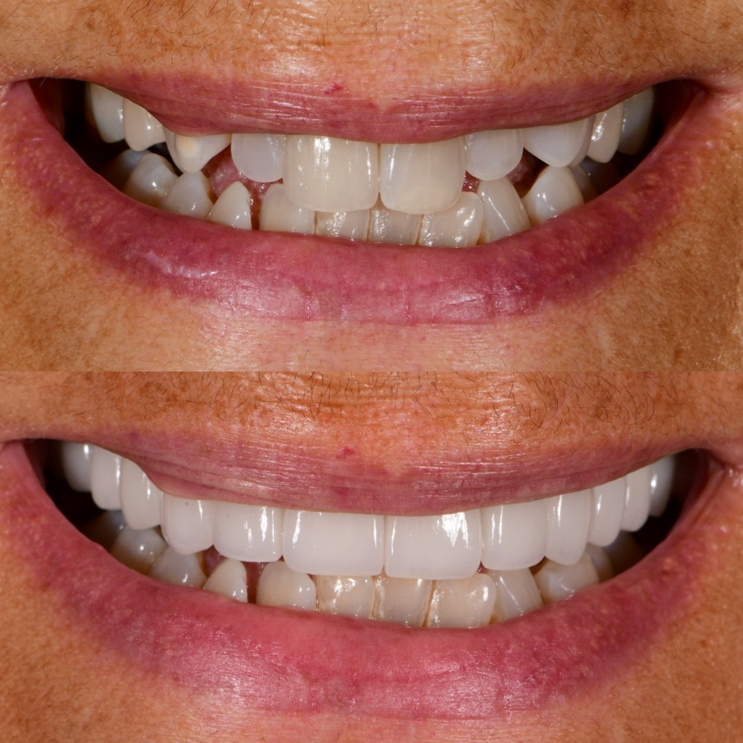 Before and after: upper porcelain veneers
