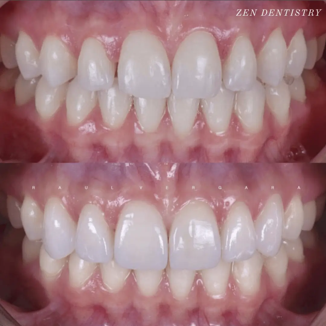 Before and after: upper six porcelain veneers