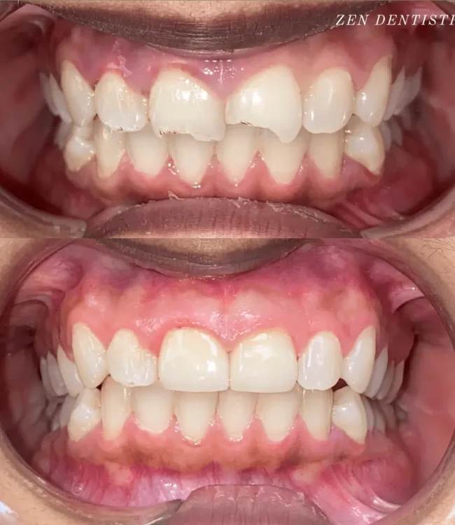 Before and after: crowded teeth aligned