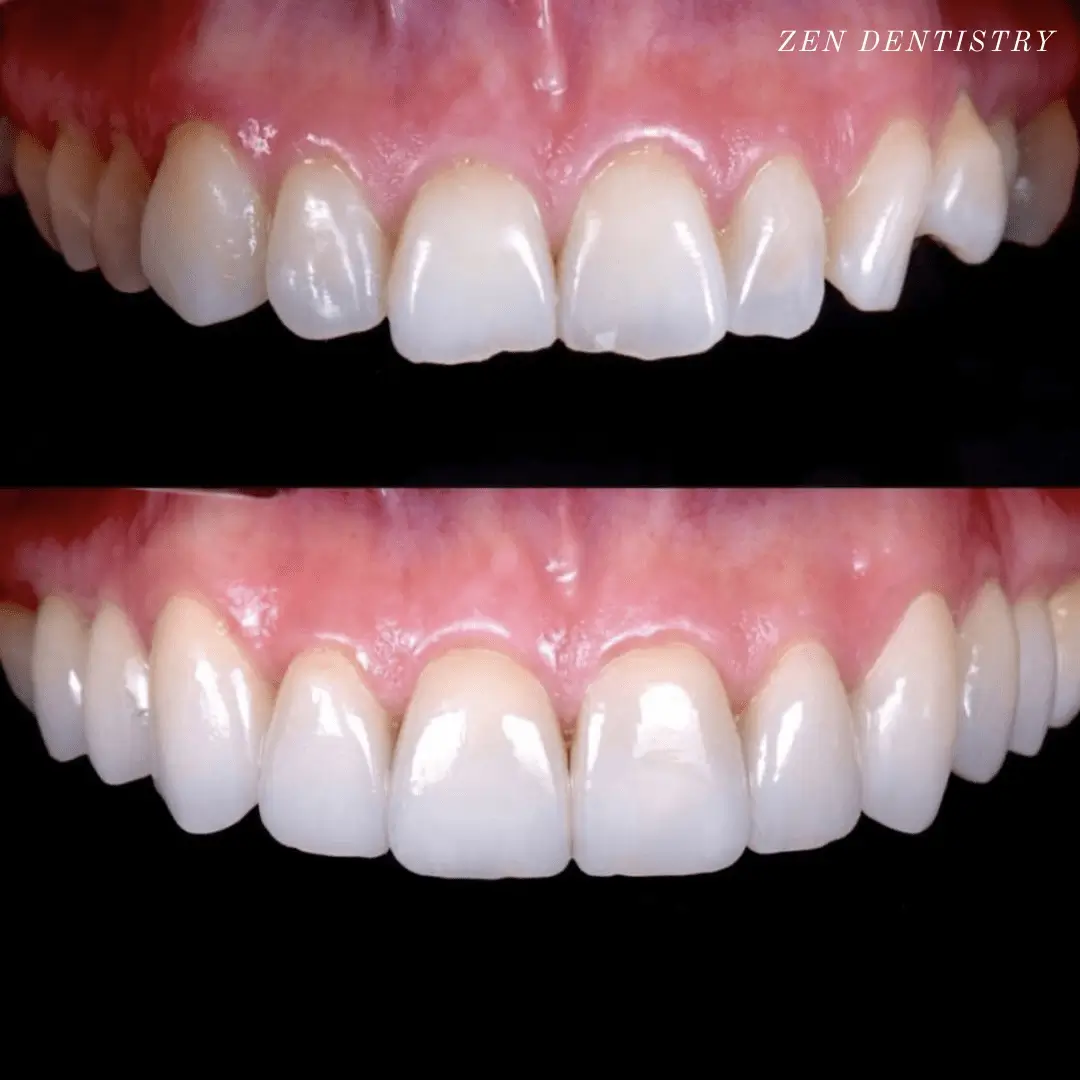 Before and after: full mouth rehabilitation with porcelain veneers