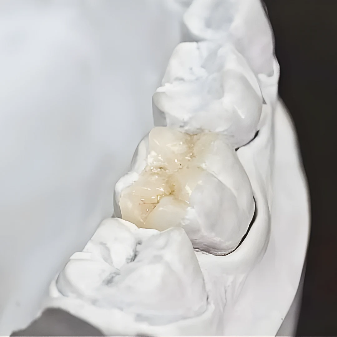Dental crown on a plaster model — periodontal dentistry