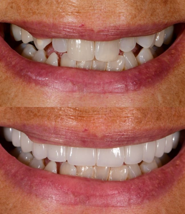 Before and after: bright porcelain veneers