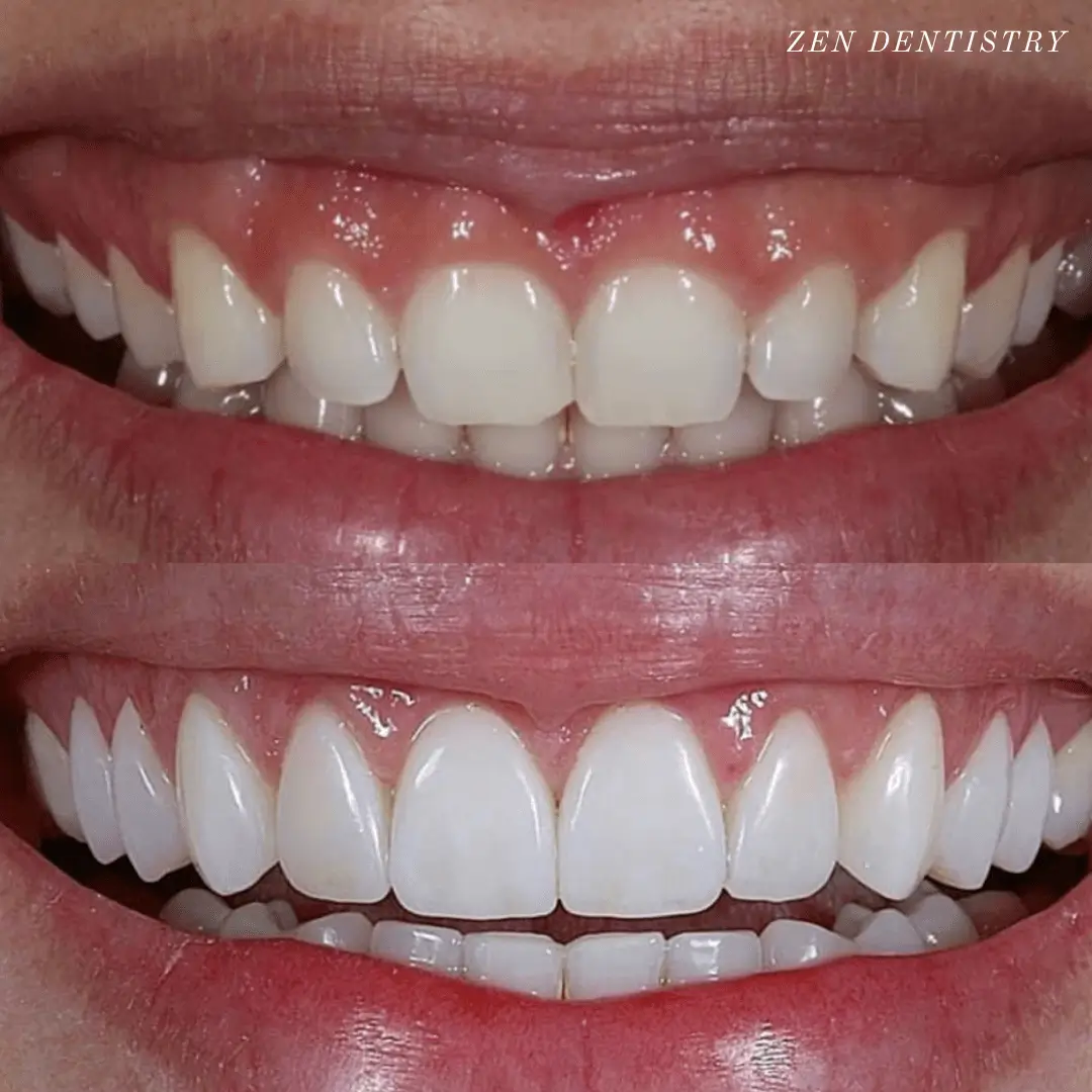 Before and after: gum lift with porcelain veneers